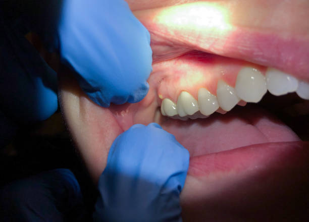 Best Emergency Treatment for Oral Infections in Shoreview, MN